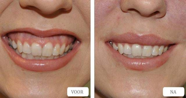 Kan je een Gummy smile behandelen met rimpel injecties?